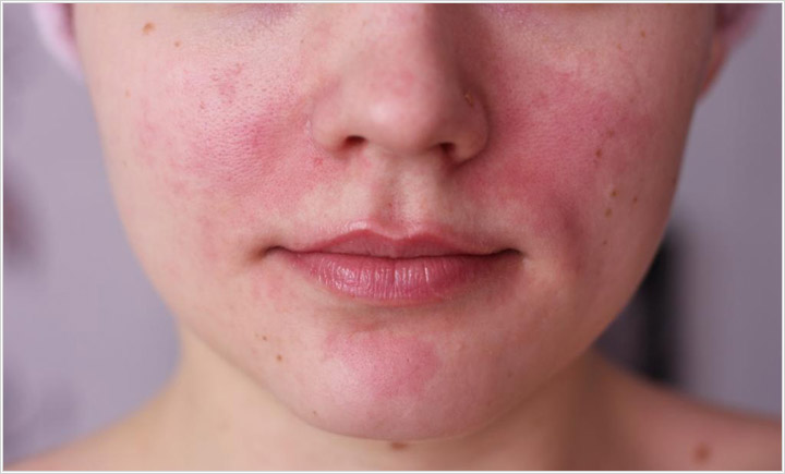 Заболевание кожи лица: его происхождение и симптомы