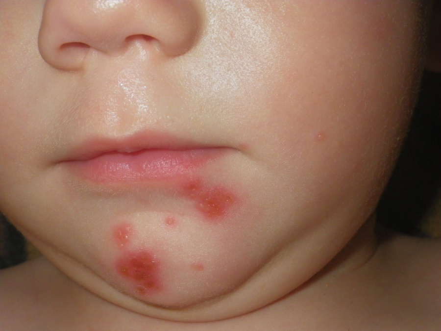 Причины появления стрептодермии у ребенка