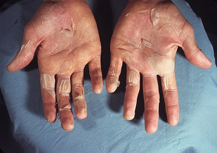 Кончики пальцев шелушатся – лечение