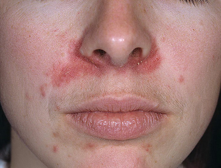 Причины возникновения дерматита на лице