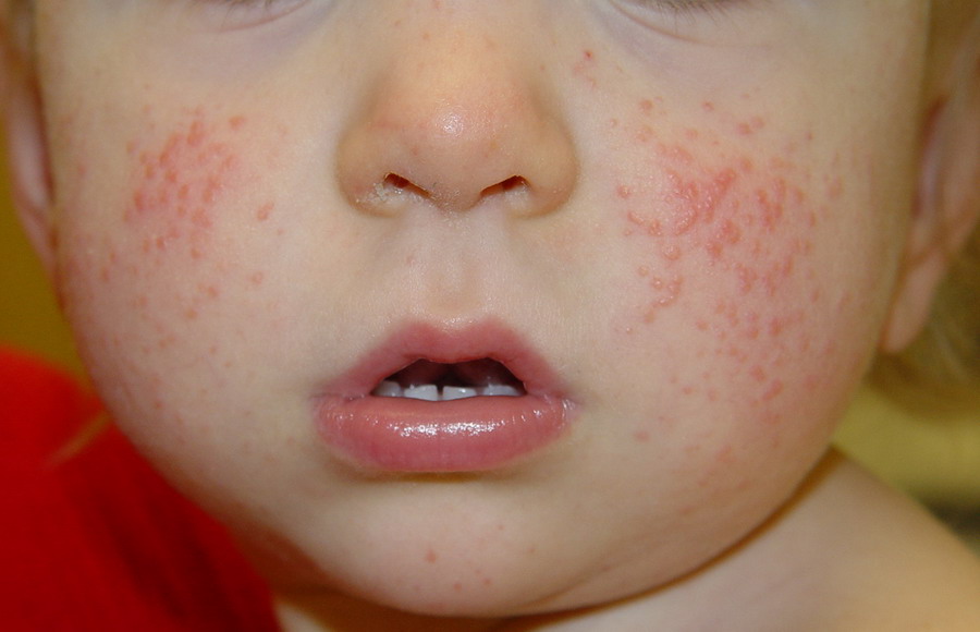 Симптоматика сыпи на лице малыша