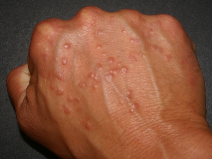 Ключевые симптомы аллергии на руках