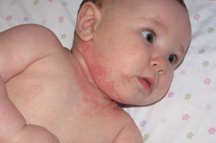 Причины атопического дерматита у детей