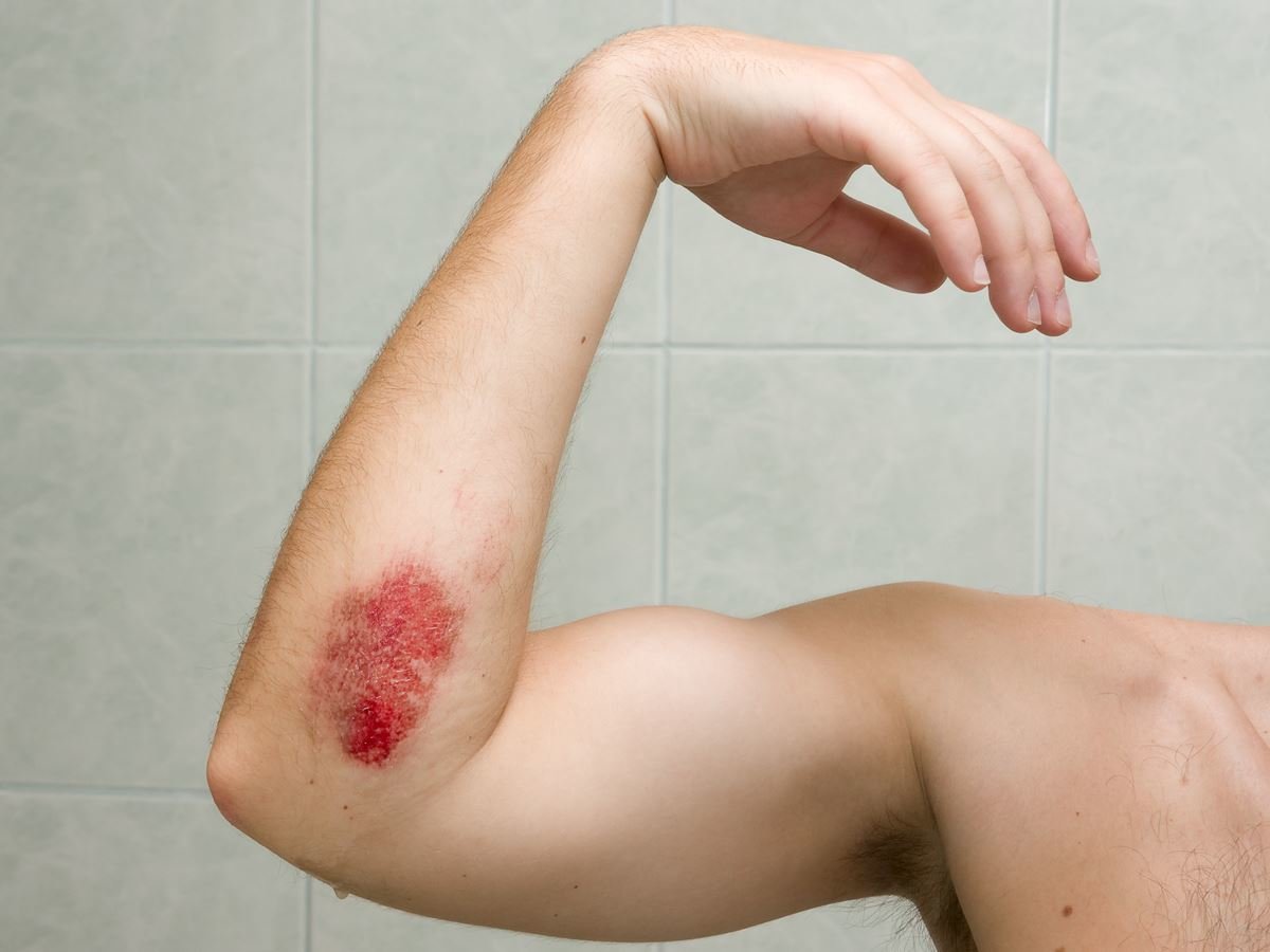 Плохо заживают раны на коже: причины