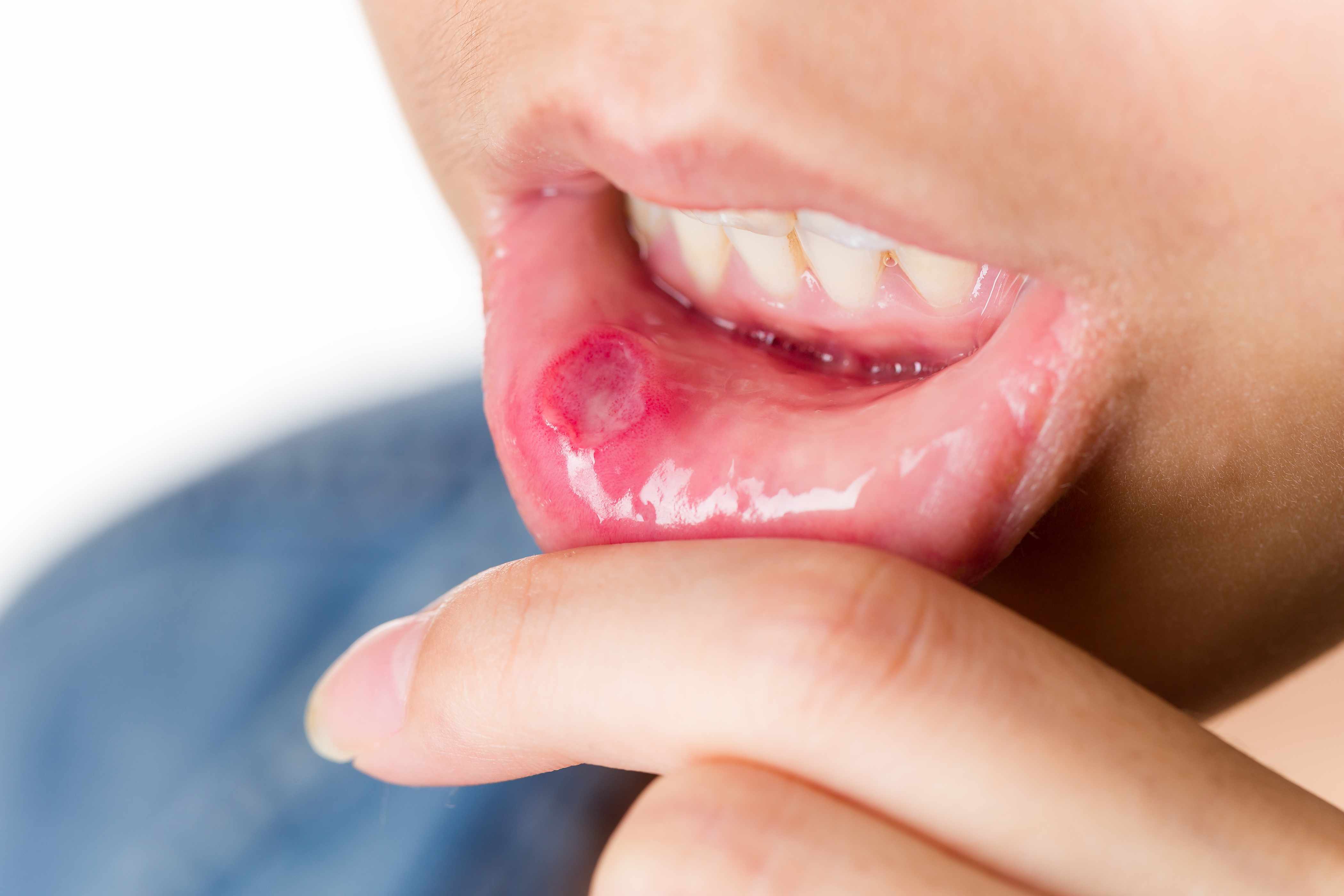 Проблема на внутренней стороне губы: симптомы герпеса
