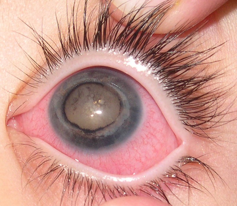 Симптомы острого приступа глаукомы