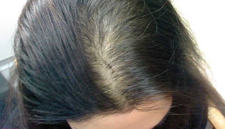 Как связаны гормоны и выпадение волос?