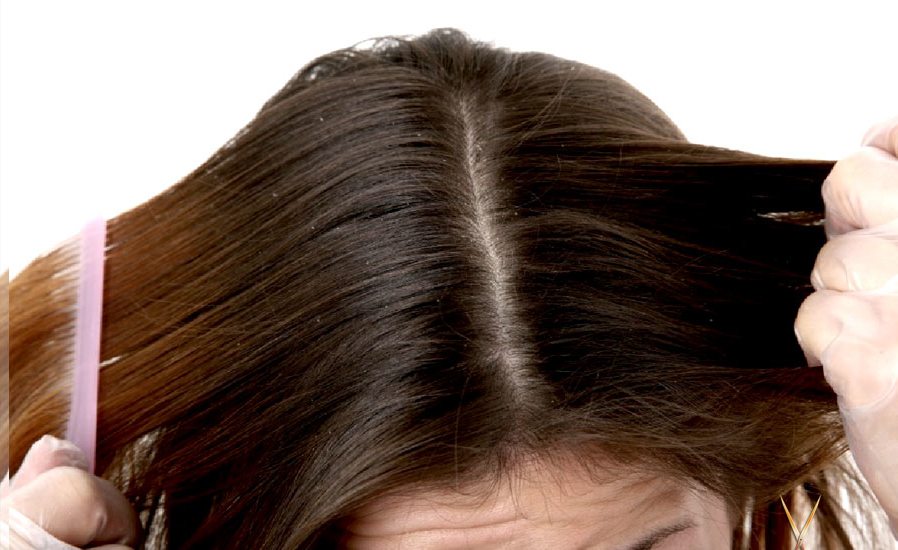 Особенности лечение грибка волосистой части головы и профилактика заболеваний