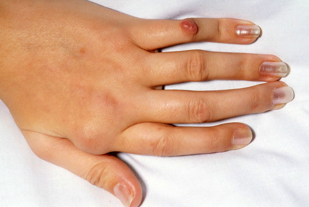 Симптомы артроза пальцев рук