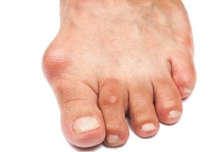 Артроз пальцев ног: описание проблемы