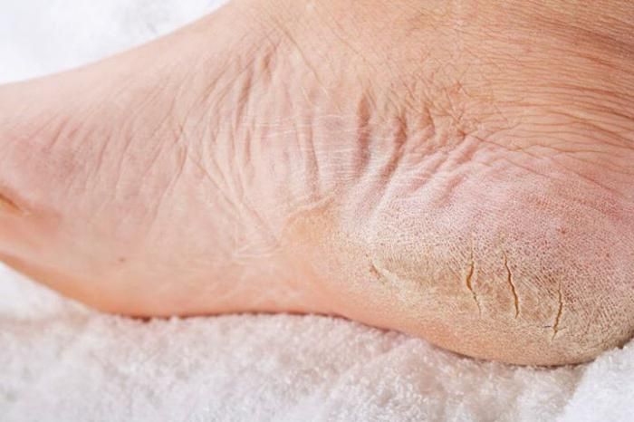 Лечение сильного шелушения кожи ног
