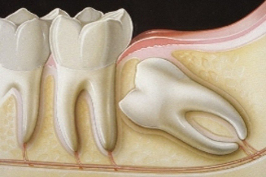 Наиболее распространенные симптомы роста зуб мудрости
