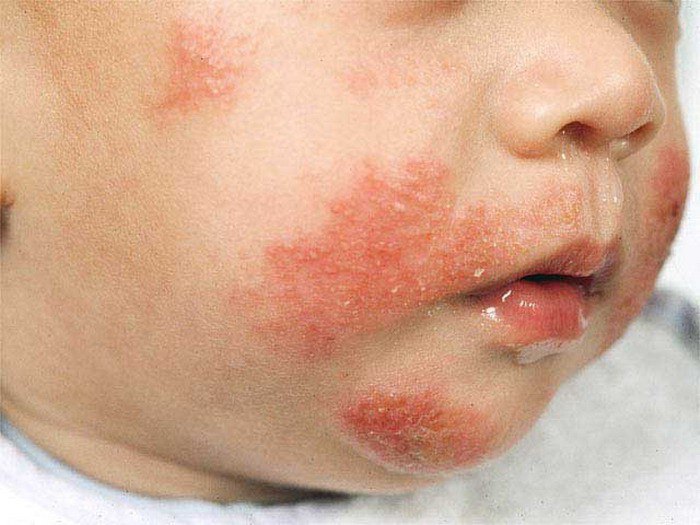 Симптомы аллергического дерматита у взрослых и детей