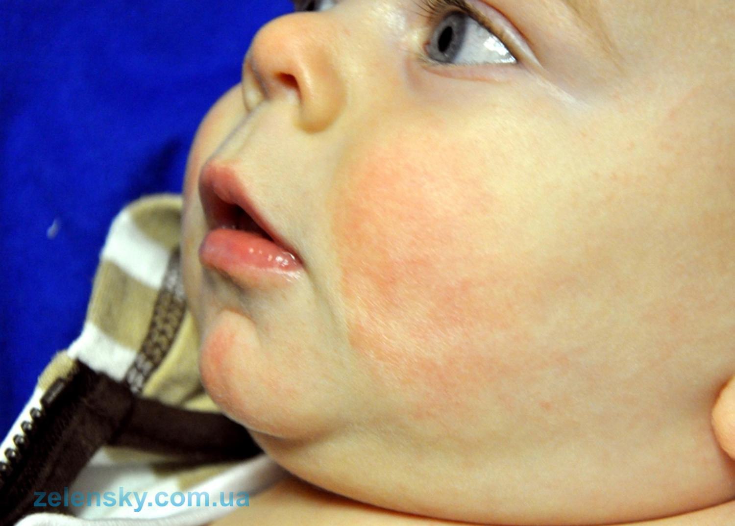 Классификация и проявления атопического дерматита у детей